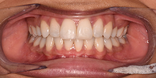 After the treatment which involved composite bonding and teeth whitening our patient's smile gave him more confidence.